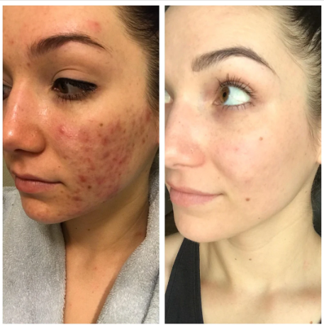Cystic Hormonal Acne: The Real Cause, Why Nothing Worked, and the System That Finally Brings Control